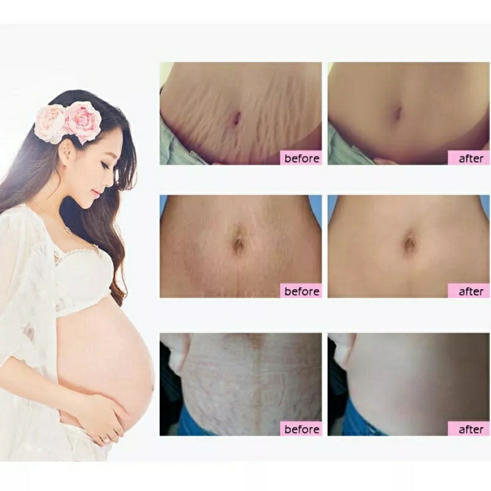 RtopR scar removal cream
